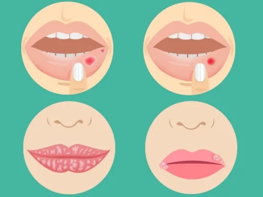 Sëmundjet serioze që mund të dalloni në buzët tuaja – nga kanceri te pneumonia