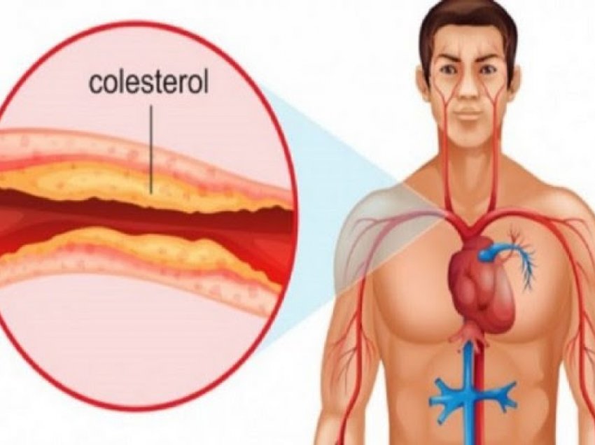 ​Simptomat e kolesterolit të lartë që nuk duhen neglizhuar