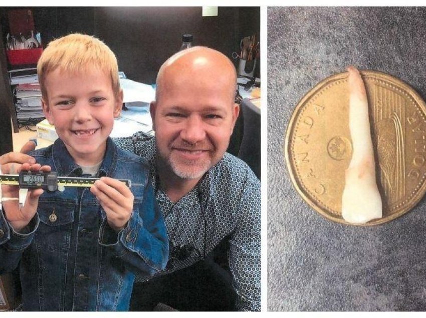 Dhëmbi mbi 2 centimetërsh i djaloshit kanadez bëhet rekord botëror