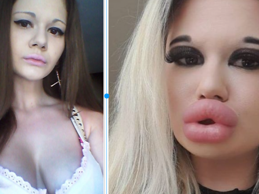 Gruaja me buzët më të mëdha në botë, rrezikon t’i “shpërthejnë”