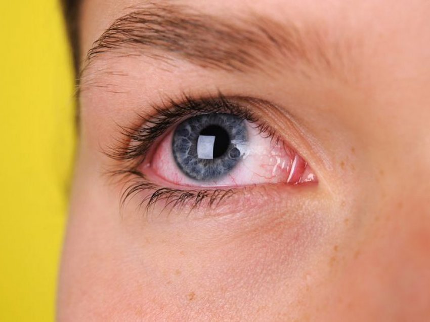 Sytë e pezmatuar janë simptomë e rëndësishme për kërkimin e koronavirusit, zbulon studimi i ri