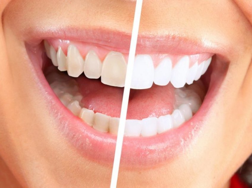 Për dhëmbë të bardhë, ndiqni këto truke të thjeshta
