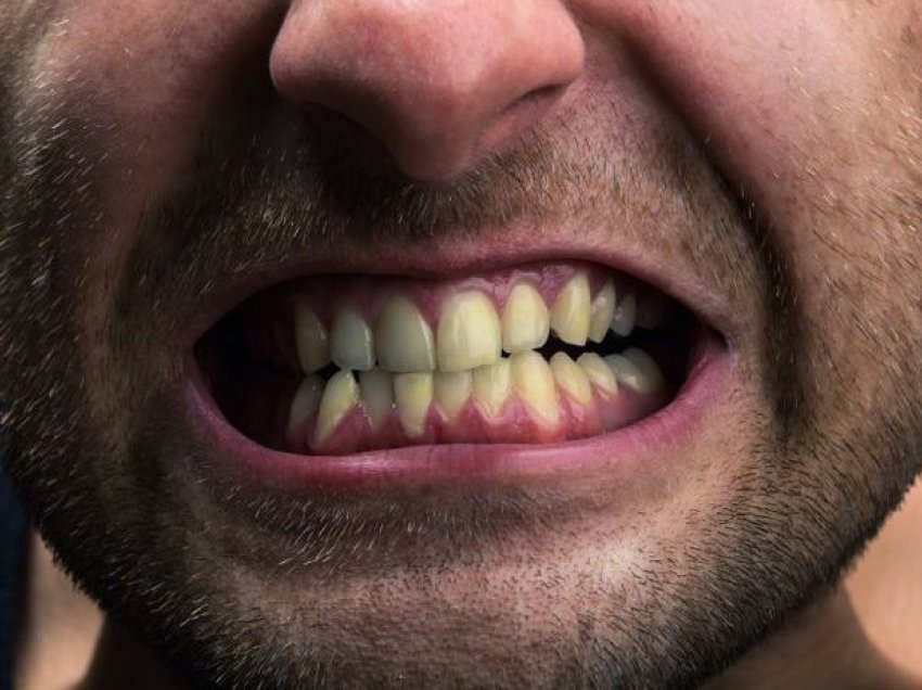 Këto zakone dëmtojnë dhe zverdhin dhëmbët tuaj