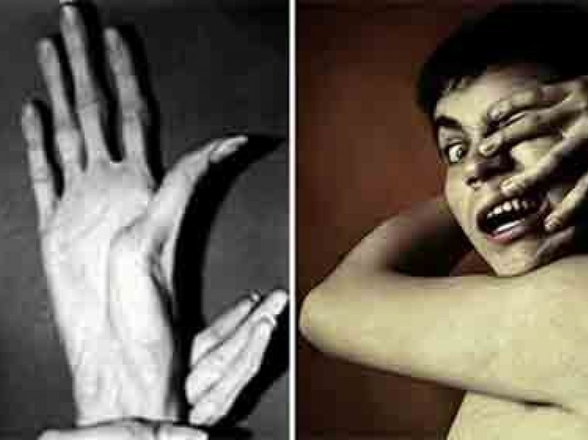 Çfarë është sindroma e dorës së alienit?