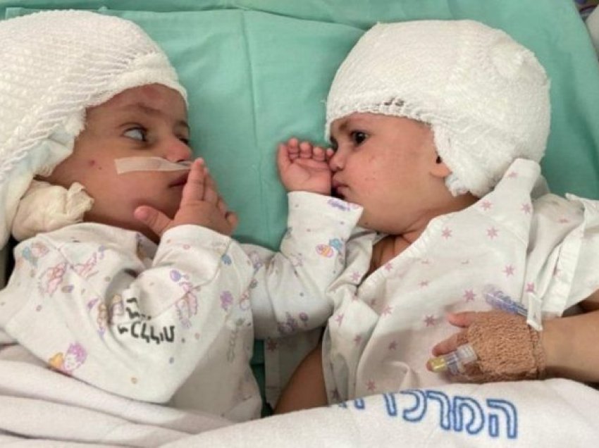 Në Izrael janë ndarë pas një operacioni të rrallë binjaket “e bashkuar kokë më kokë”