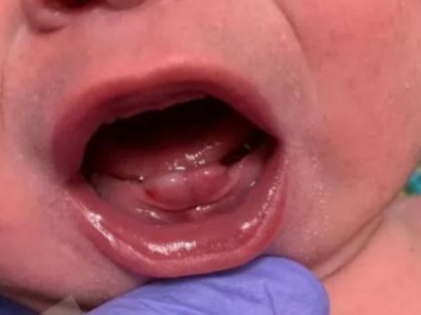 Foshnja që lindi me dhëmbë