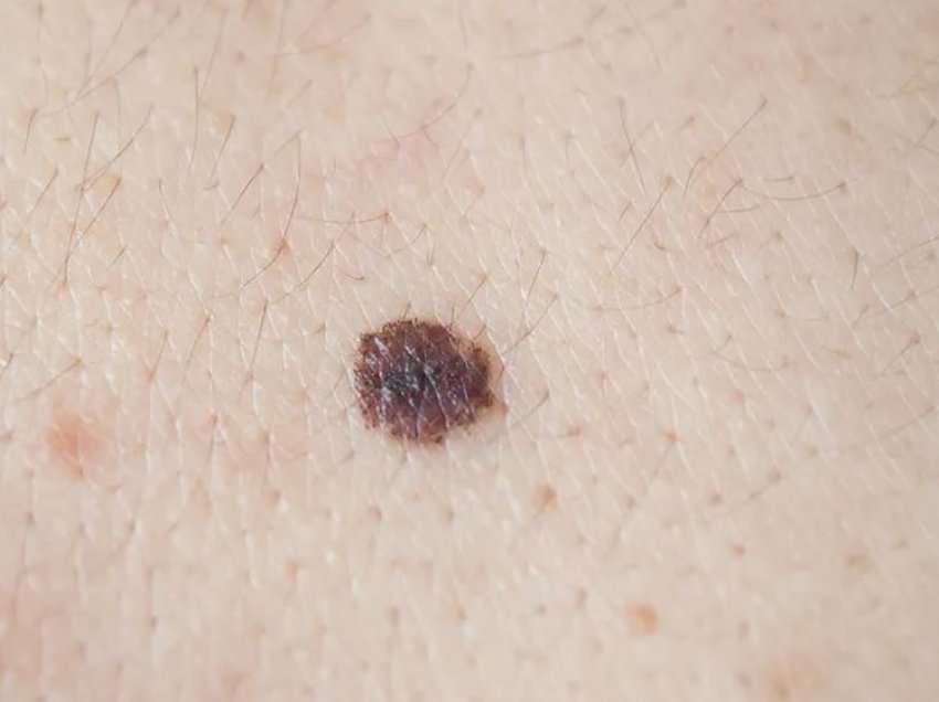 Testi i gjakut mund të diagnostikojë saktë melanomën, zbulon studimi