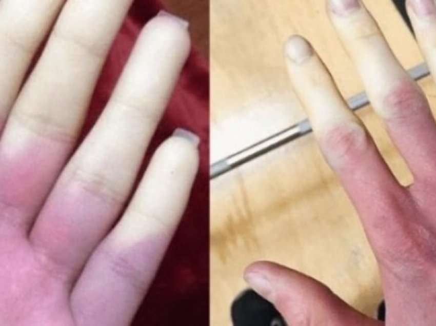 Këto janë simptomat e sëmundjes që ndryshon ngjyrën e gishtërinjëve