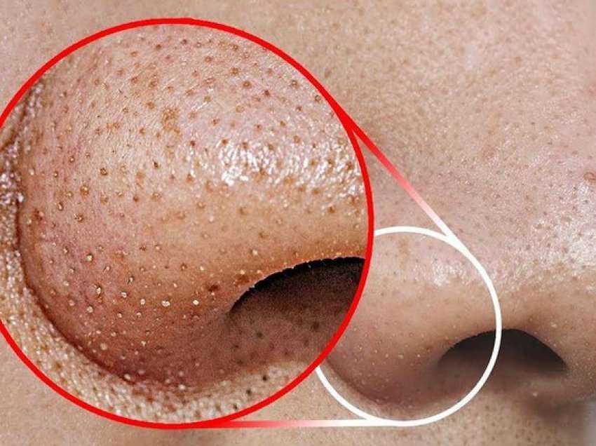 Sipas shumë blogger-eve për të hequr pikat e zeza në hundë mjafton ky trajtim