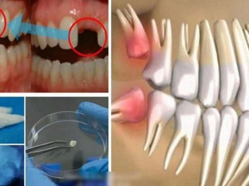 Mirupafshim implante dentare, tani dhëmbët rriten në vetëm 9 javë