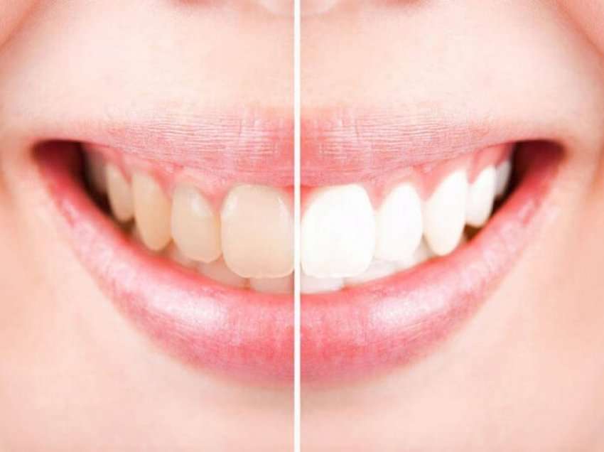 Ja si ti bëni dhëmbët tuaj të bardhë me një metodë shumë efikase