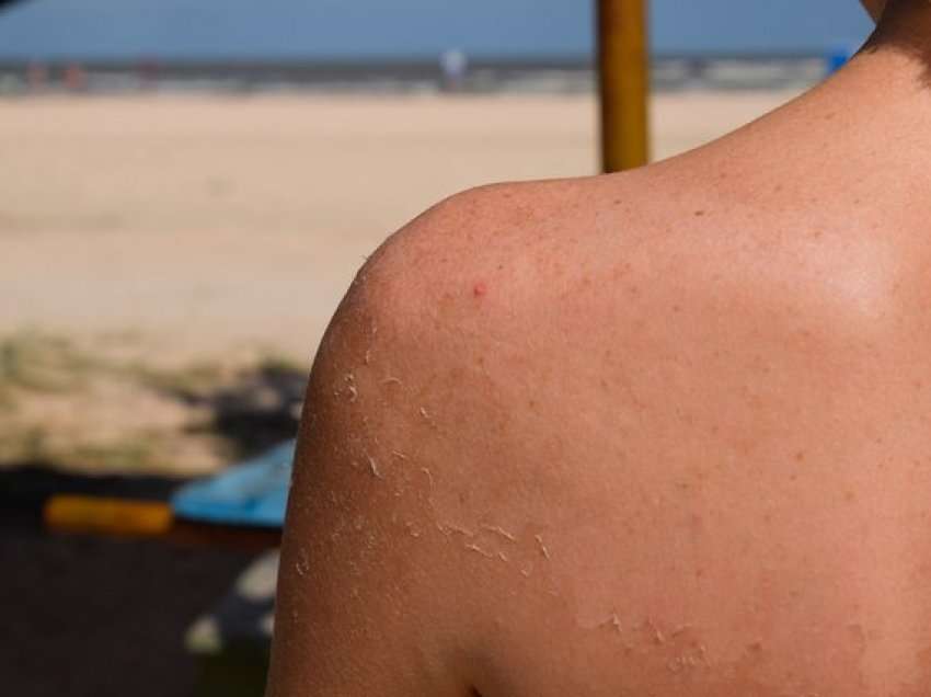 Kujdes lëkurën në plazh, dermatologia Kunesha: Deri tani rritja e infeksioneve 10%. Shpjegon shkaqet e infeksioneve