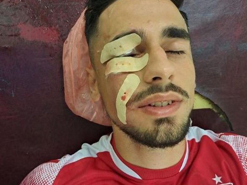 Futbollisti përfundoi me 3 të çara në fytyrë, identifikohet personi që sulmoi