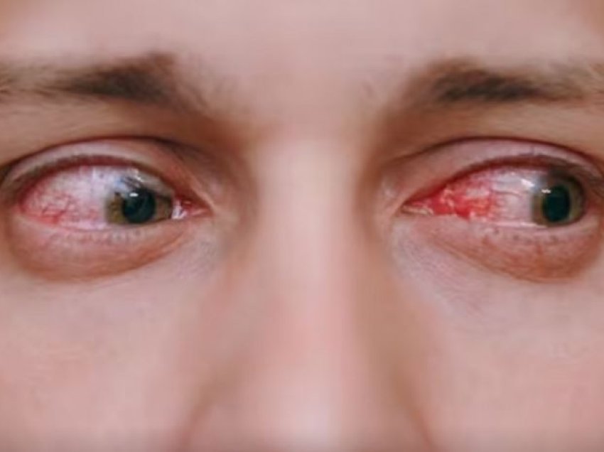 Simptomat e infeksionit të syri/ Pesë shenja paralajmëruese që nuk duhet t’i injoroni kurrë