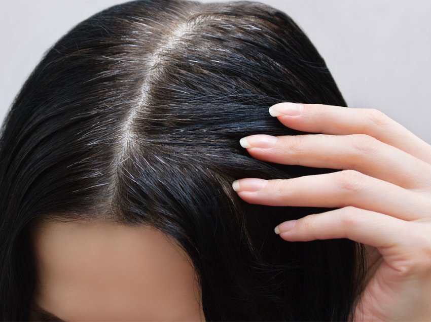 Çfarë i shkakton thinjat në flokë?