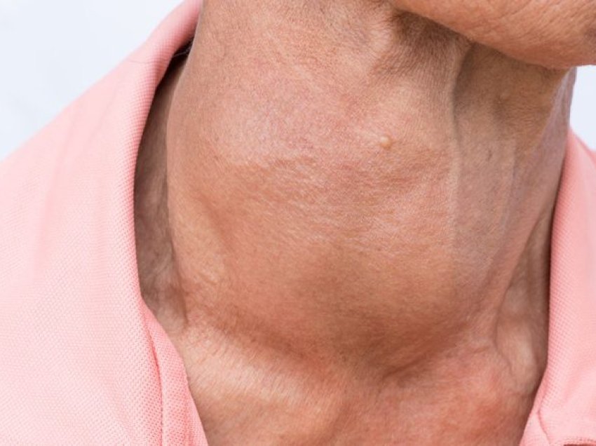 Hashimoto, sëmundja autoimune e tiroides që prek kryesisht gratë