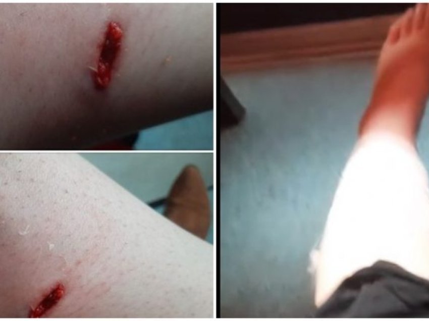 Gazetarja e RTK-së sulmohet nga qentë endacakë në Prishtinë